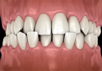 Common Problem - Crossbite